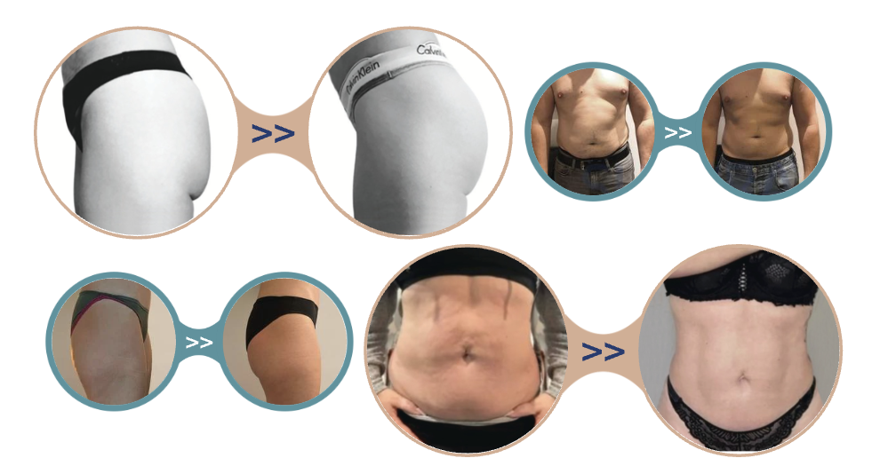 Supra sculpt avant apr&egrave;s r&eacute;sultats