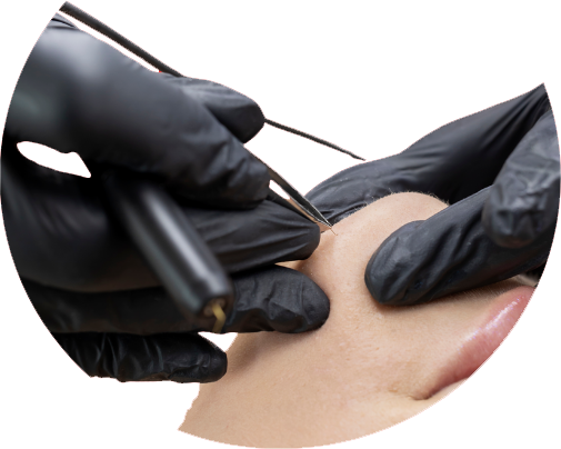 Poils du visage traités par appareil de thermolyse Épilise