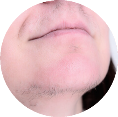 traintement thermolyse hirsutisme