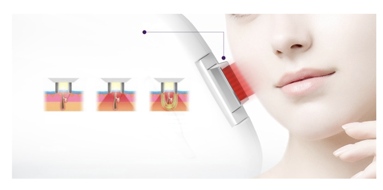 Technologie lumière pulsée