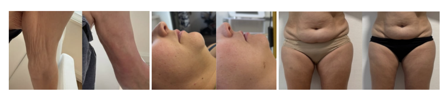 Radiofr&eacute;quence anti-&acirc;ge r&eacute;sultats avant apr&egrave;s