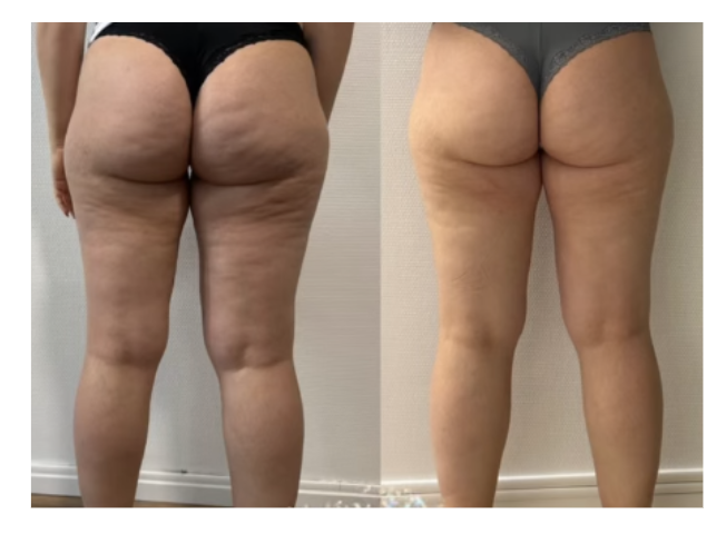 Radiofr&eacute;quence corps professionnel r&eacute;sultats