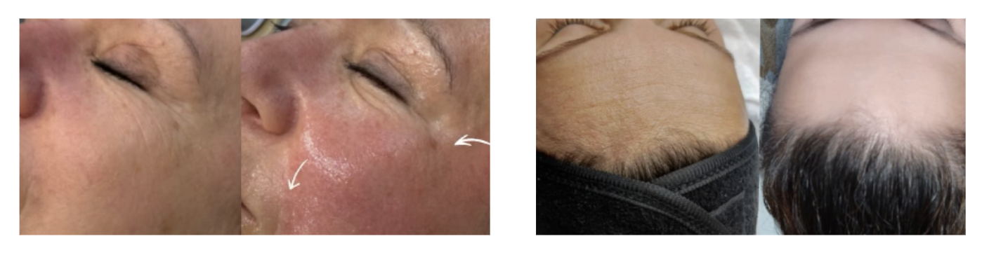 Radiofr&eacute;quence esth&eacute;tique visage r&eacute;sultats