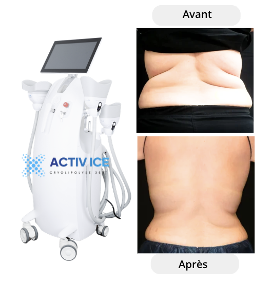 Appareil minceur efficace avant apr&egrave;s